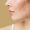 Young woman before and after acne treatment. Skin care concept